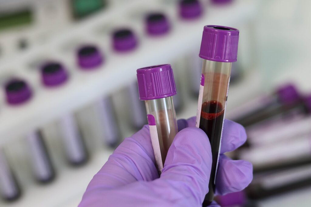 Schilddrüsen-Blutwerte können ganz einfach und schnell im Labor ermittelt werden.
